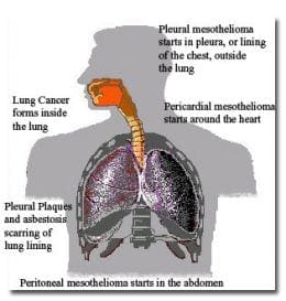Malignant mesothelioma, lung cancer, asbestosis, pleural plaques