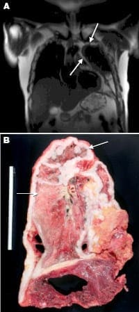 Pleural mesothelioma as seen by radiology and pathology